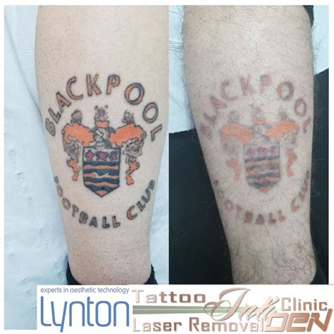 Blackpool Laser Tattoo Removal Inkden Clinic Laser Tattoo Removal