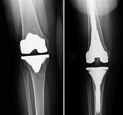 Component Loosening In Knee Replacement Devices Knee Replacement