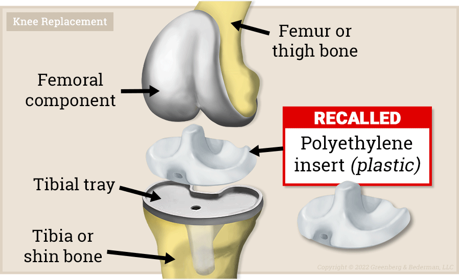 Exactech Knee Ankle Insert Recall Lawsuit 2022