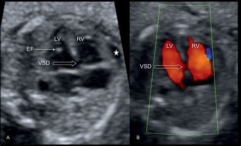 Fetal Vsd Ultrasound