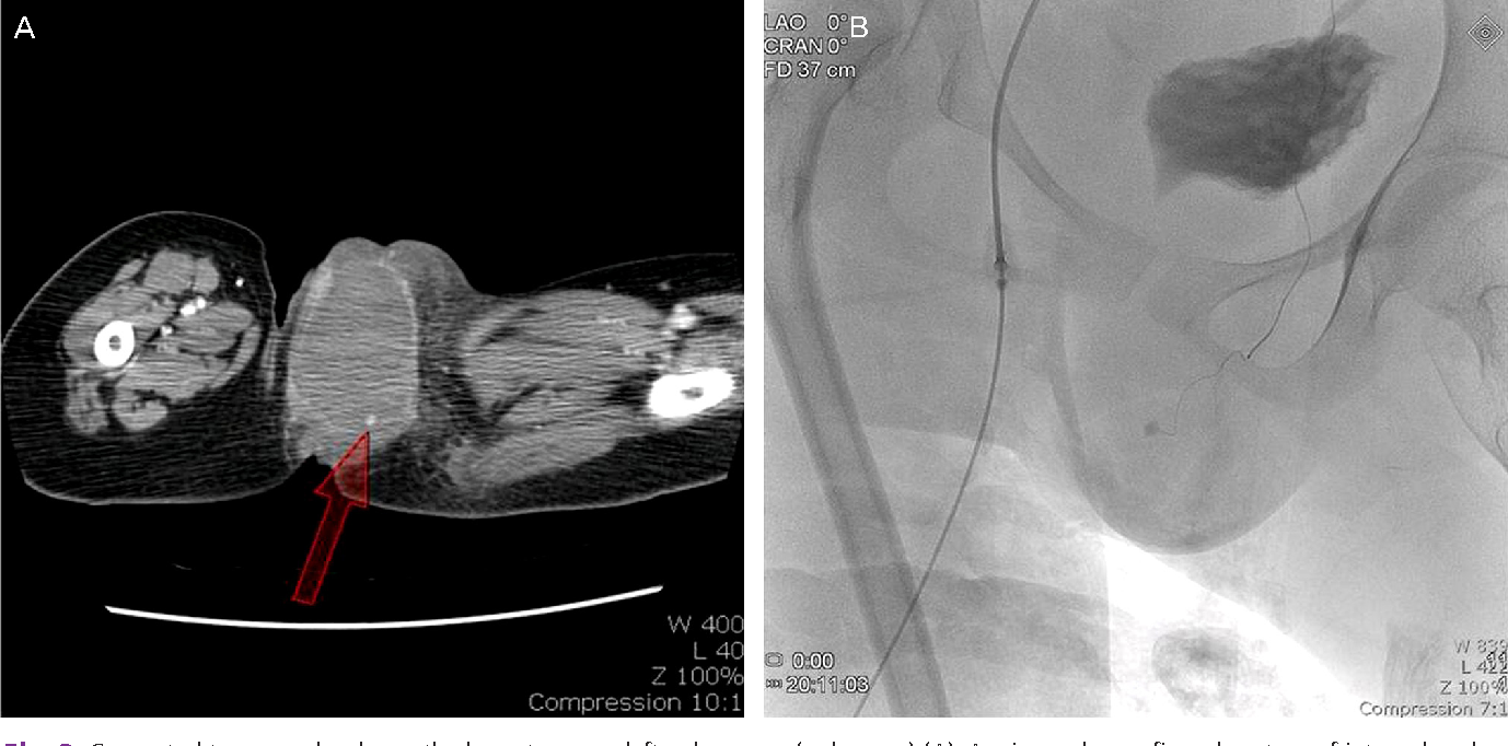 Figure 2 From A Case Of Vulvar Hematoma With Rupture Of Pseudoaneurysm