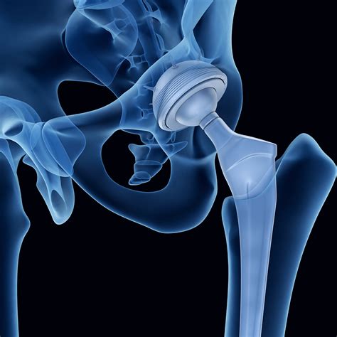 Hip Replacement Lawsuit 2020 Recalls Settlements