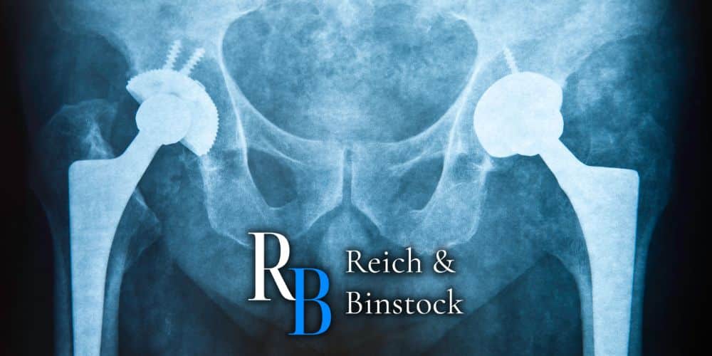 Houston Hip Replacement Lawsuit Reich Binstock