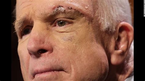 John Mccain Bruised Eye