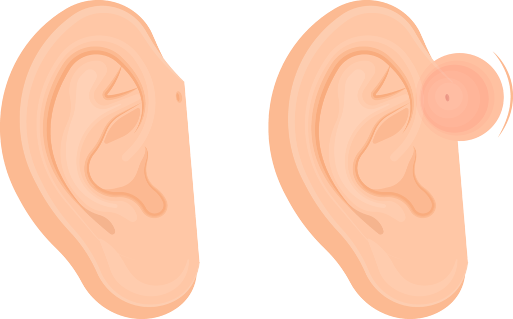 Pre-Auricular Region Filler Placement