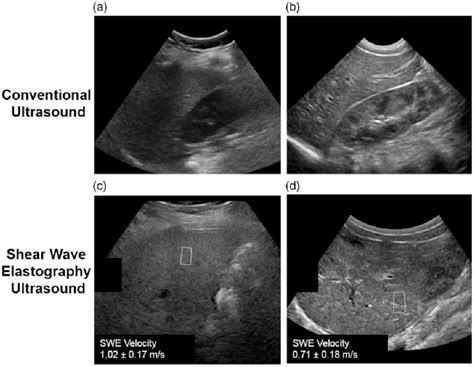 Ultrasound Images In Two Obese Patients A C An 11 Year Old Boy And