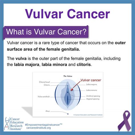 Vulvar Cancer