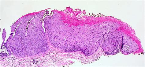 Vulvar Intraepithelial Neoplasia Grade 3 Vin 3 Biopsy O Flickr