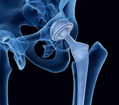 Wright Hip Replacement Lawsuits Conserve Profemur